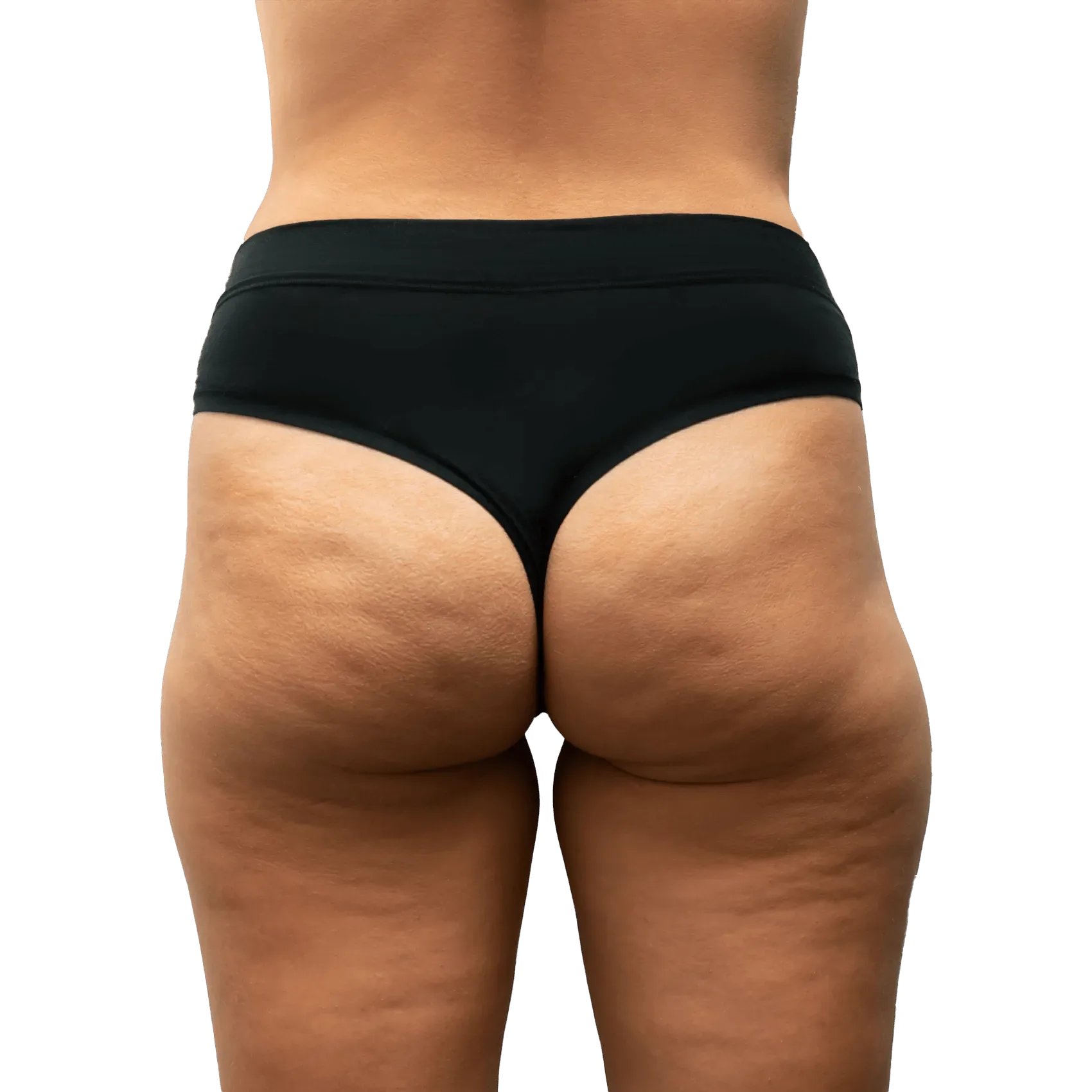 Before Thighplasty (Inner Thigh Lifting) Surgery