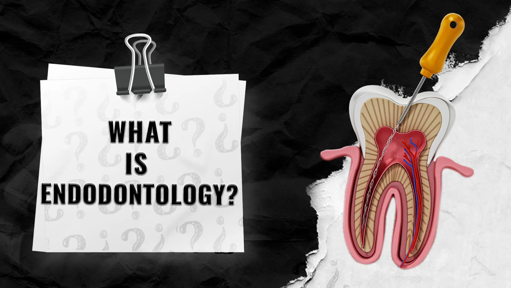 Endodontics-in-IstanbulTurkey