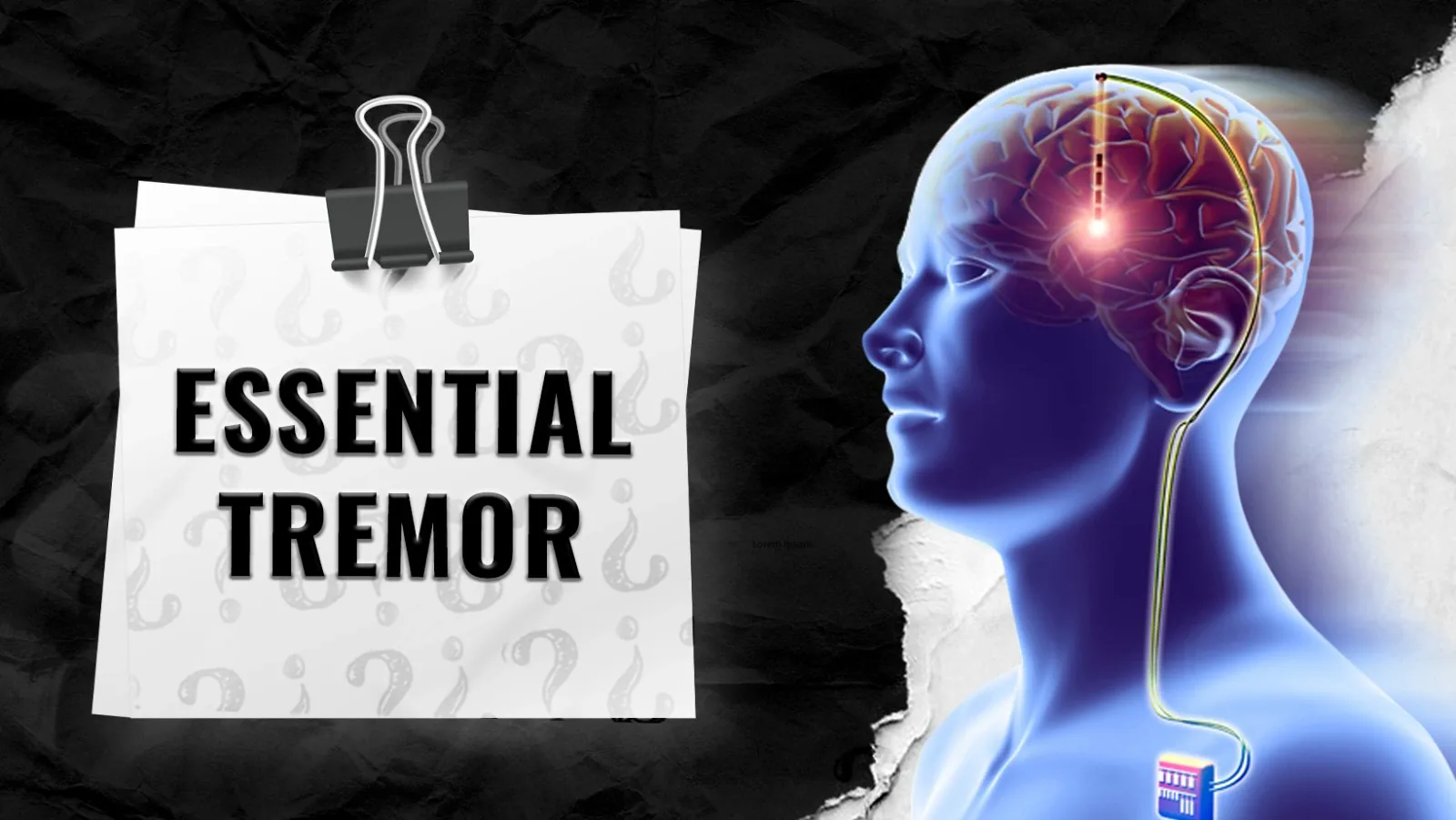 Essential-Tremor