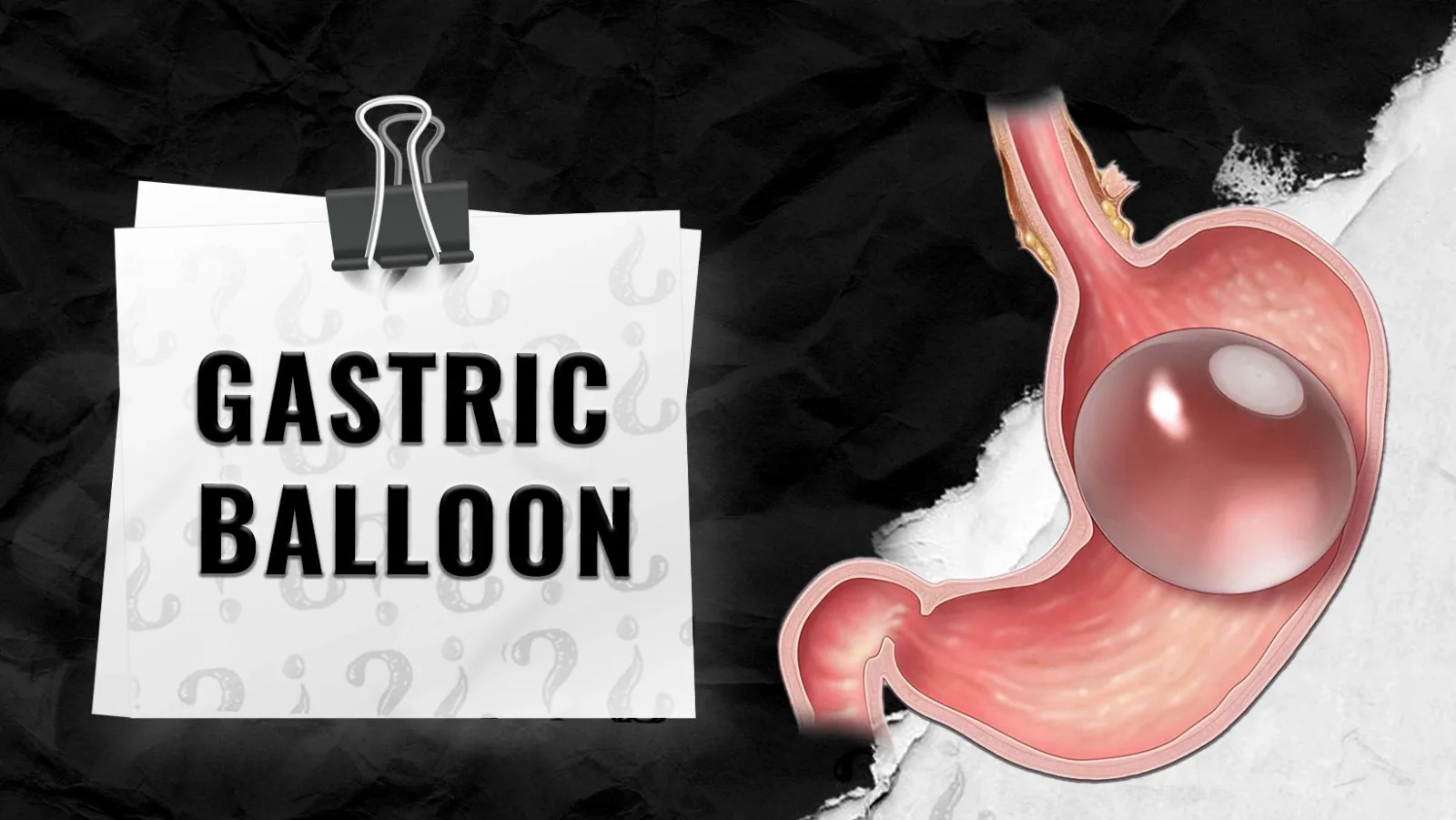 Gastric-Balloon-in-istanbulTurkey