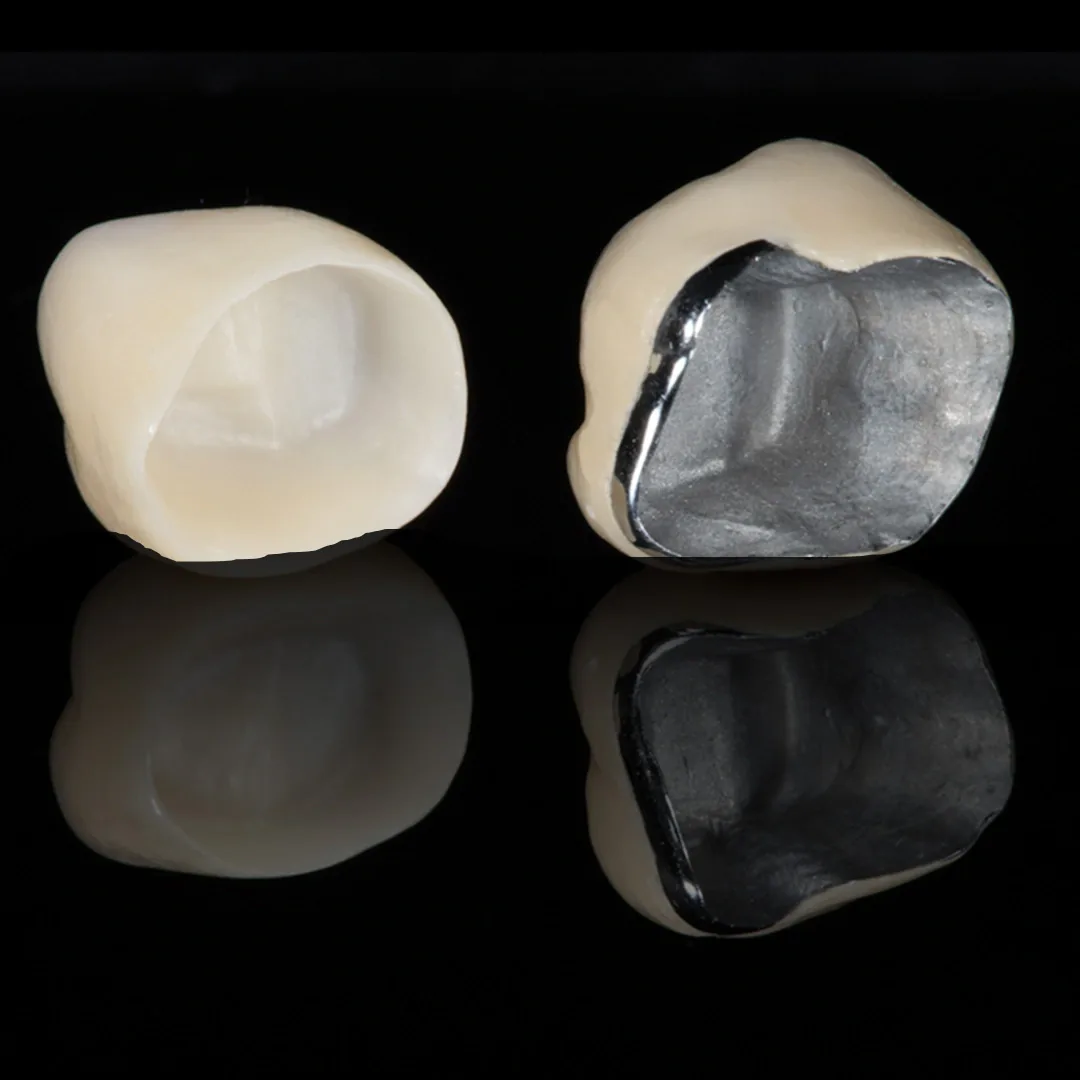 Laminate Veneers