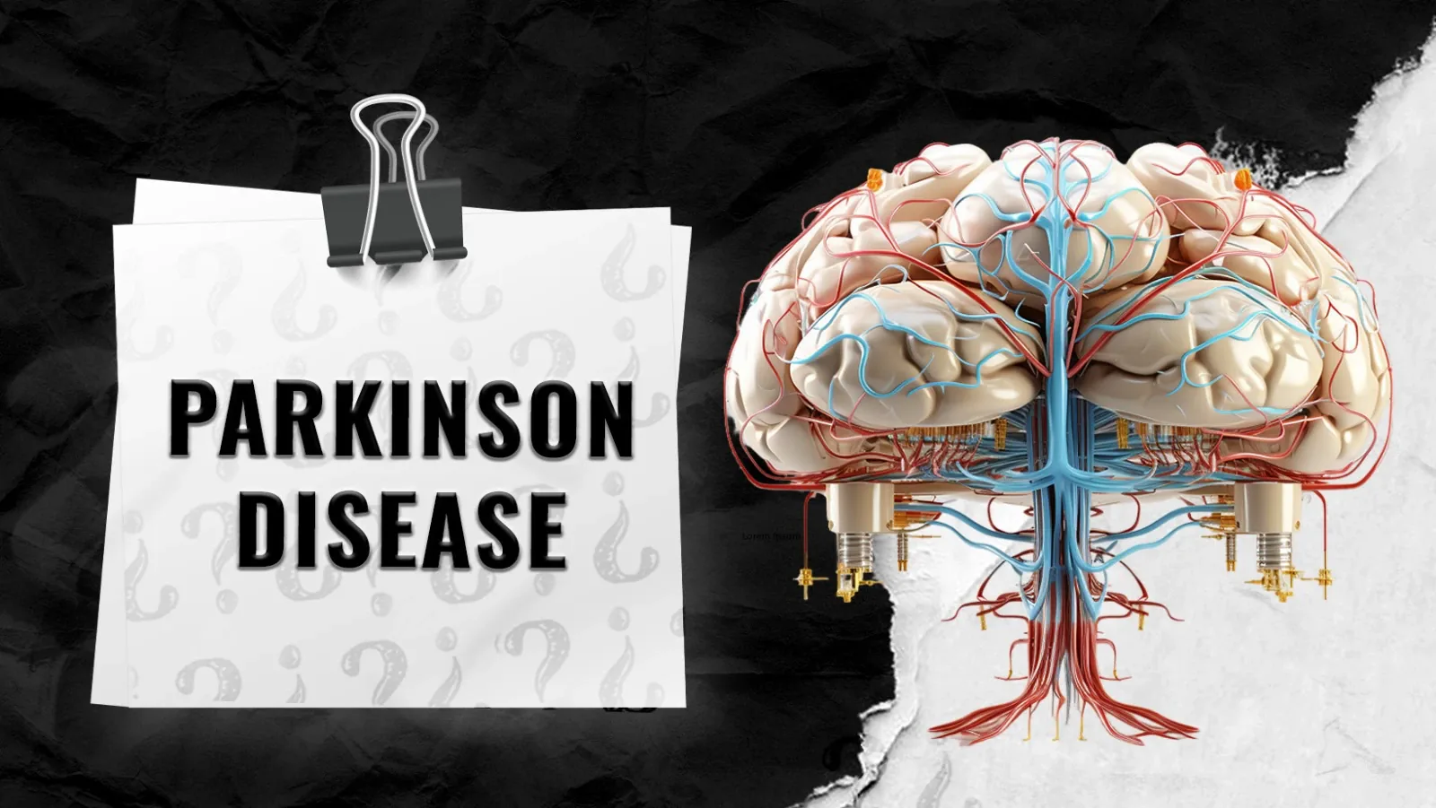 Parkinson-Disease