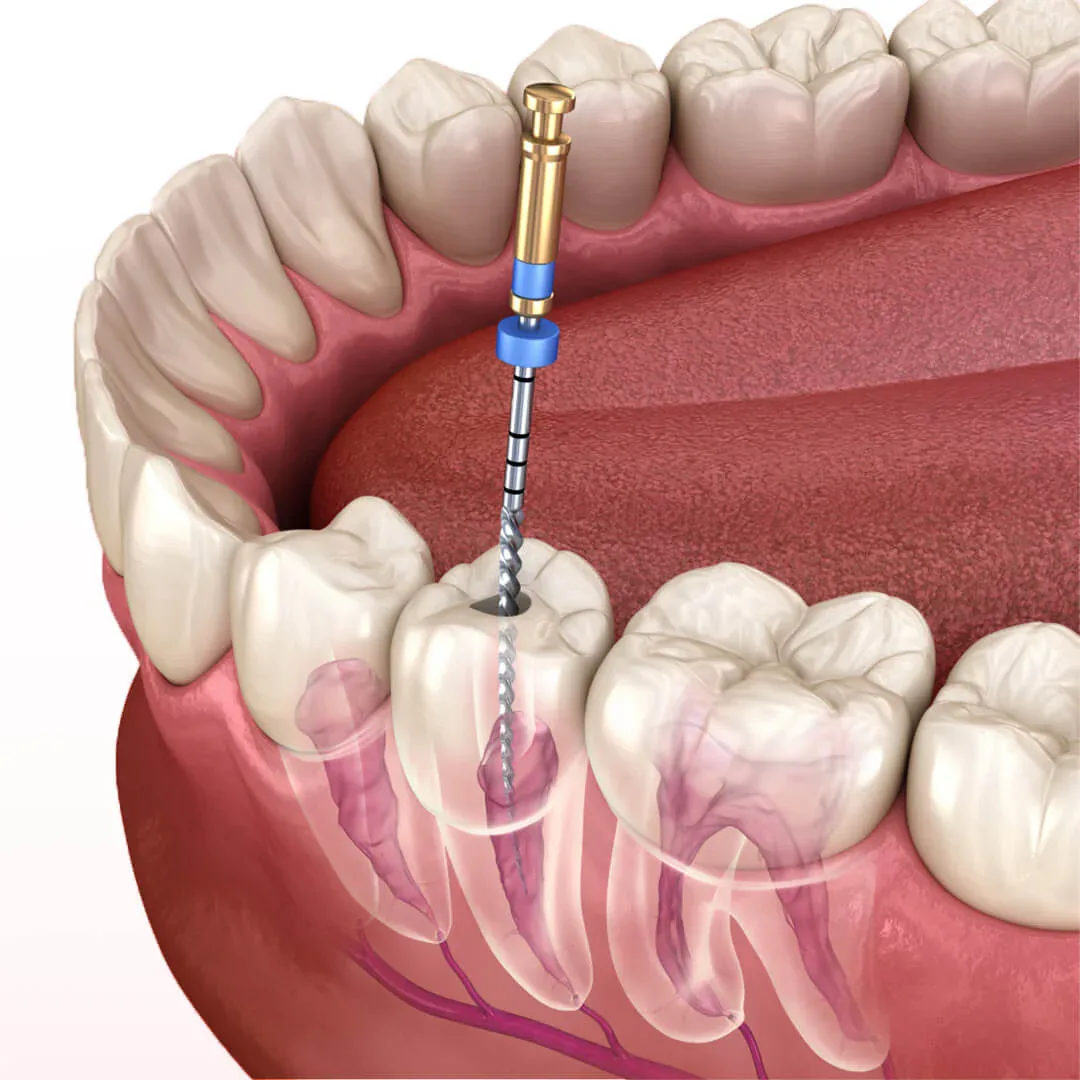 What is Endodontics What is Endodontics