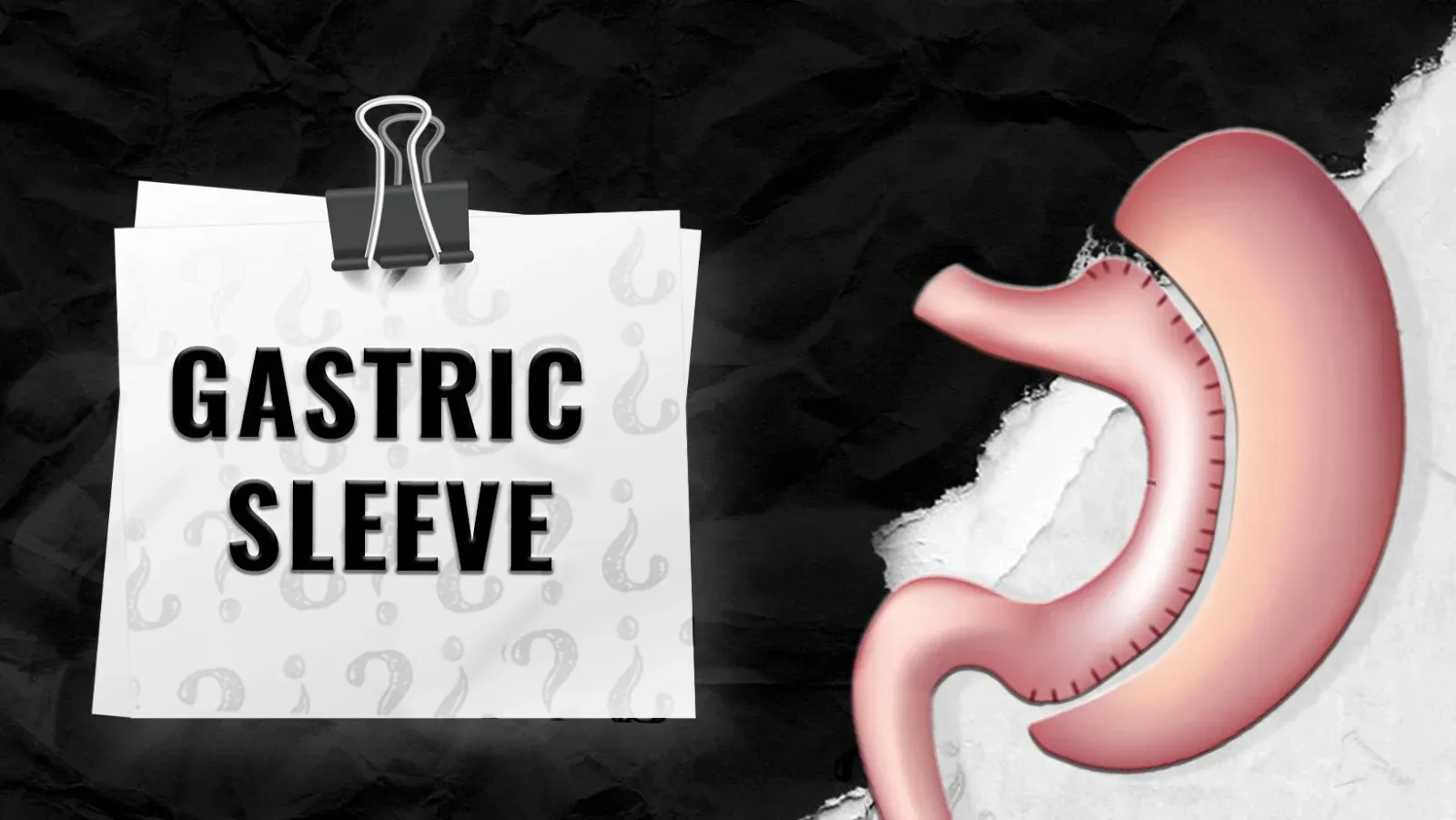 Who-qualifies-for-Gastric-Sleeve