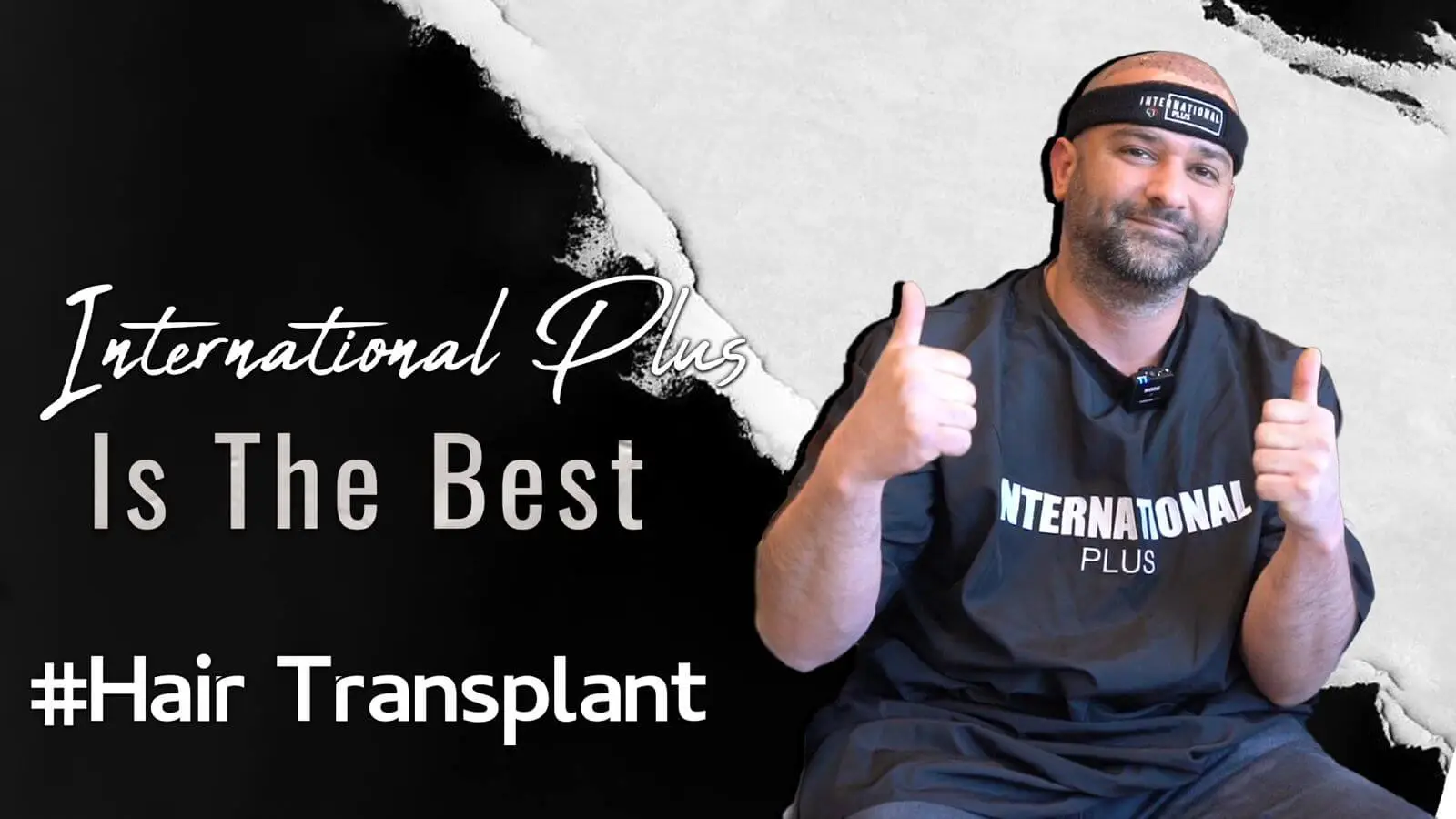 Who-qualifies-for-Hair-Transplant