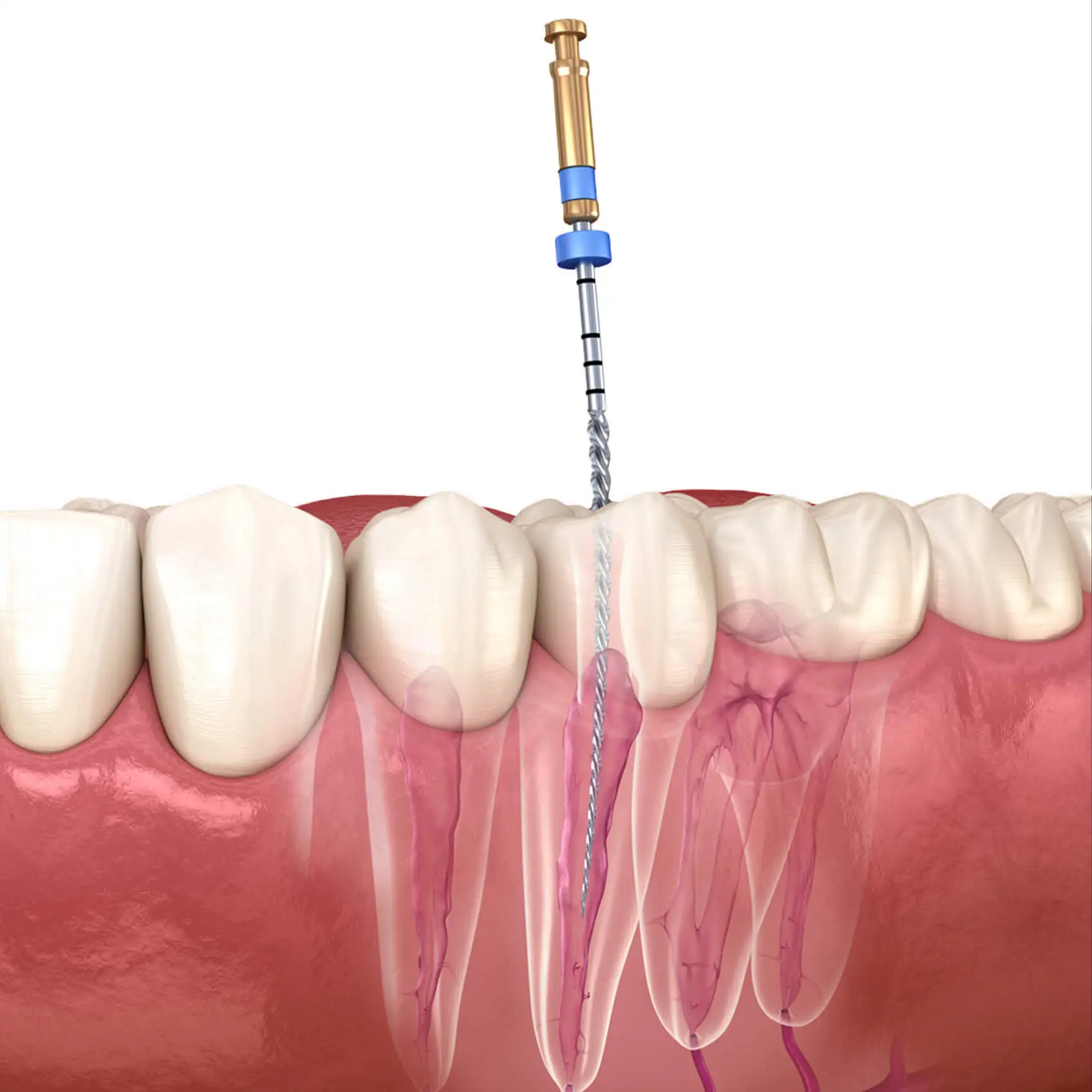 Why Choose Us for Endodontics Treatment in Istanbul, Turkey Why Choose Us for Endodontics Treatment in Istanbul, Turkey