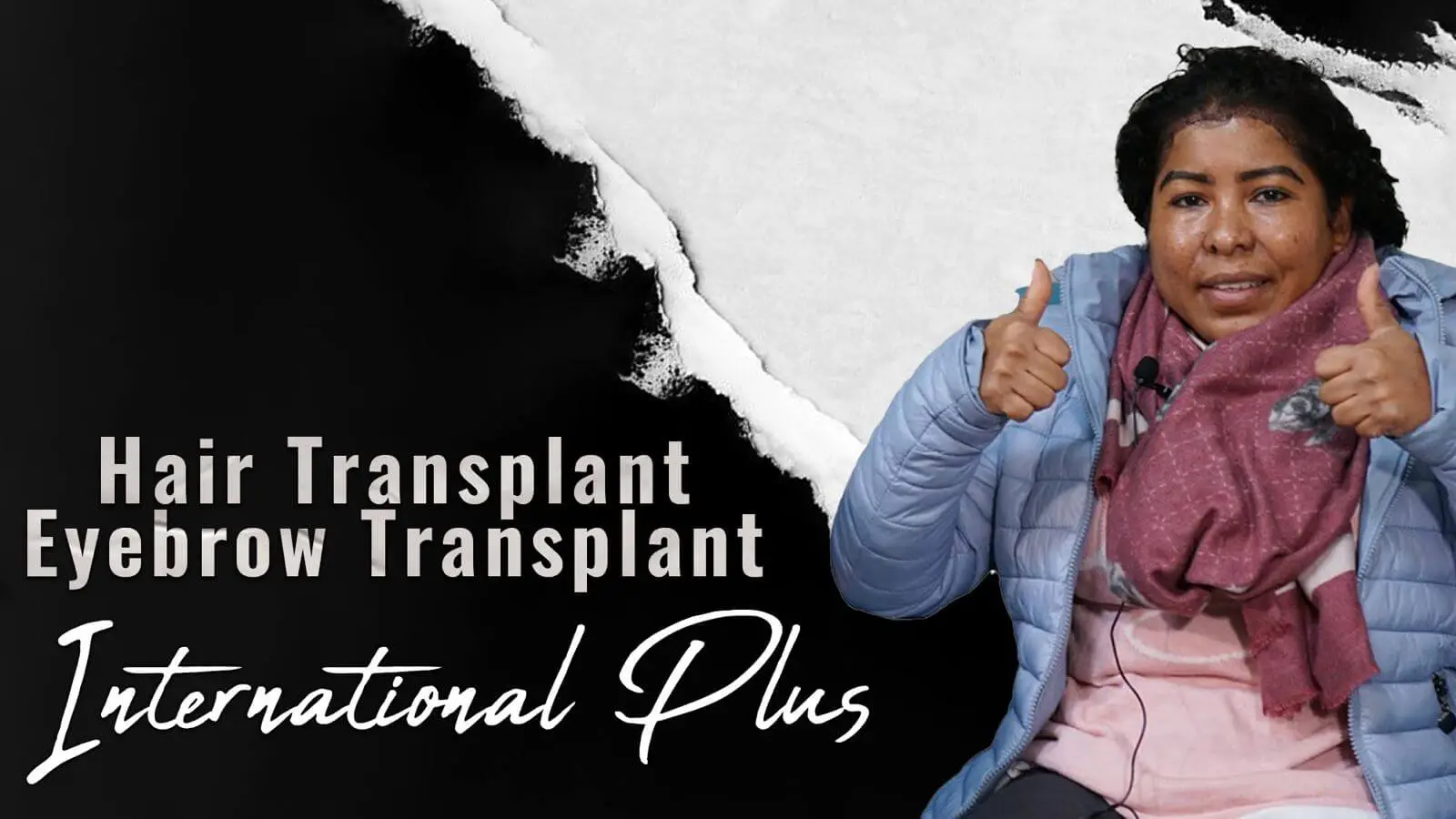 Woman-Hair-Transplant-in-istanbulTurkey