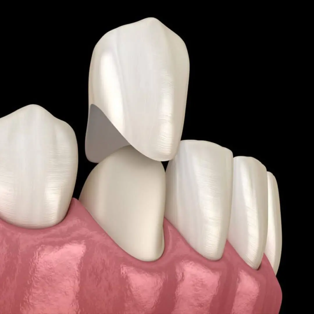 Zirconium Crown