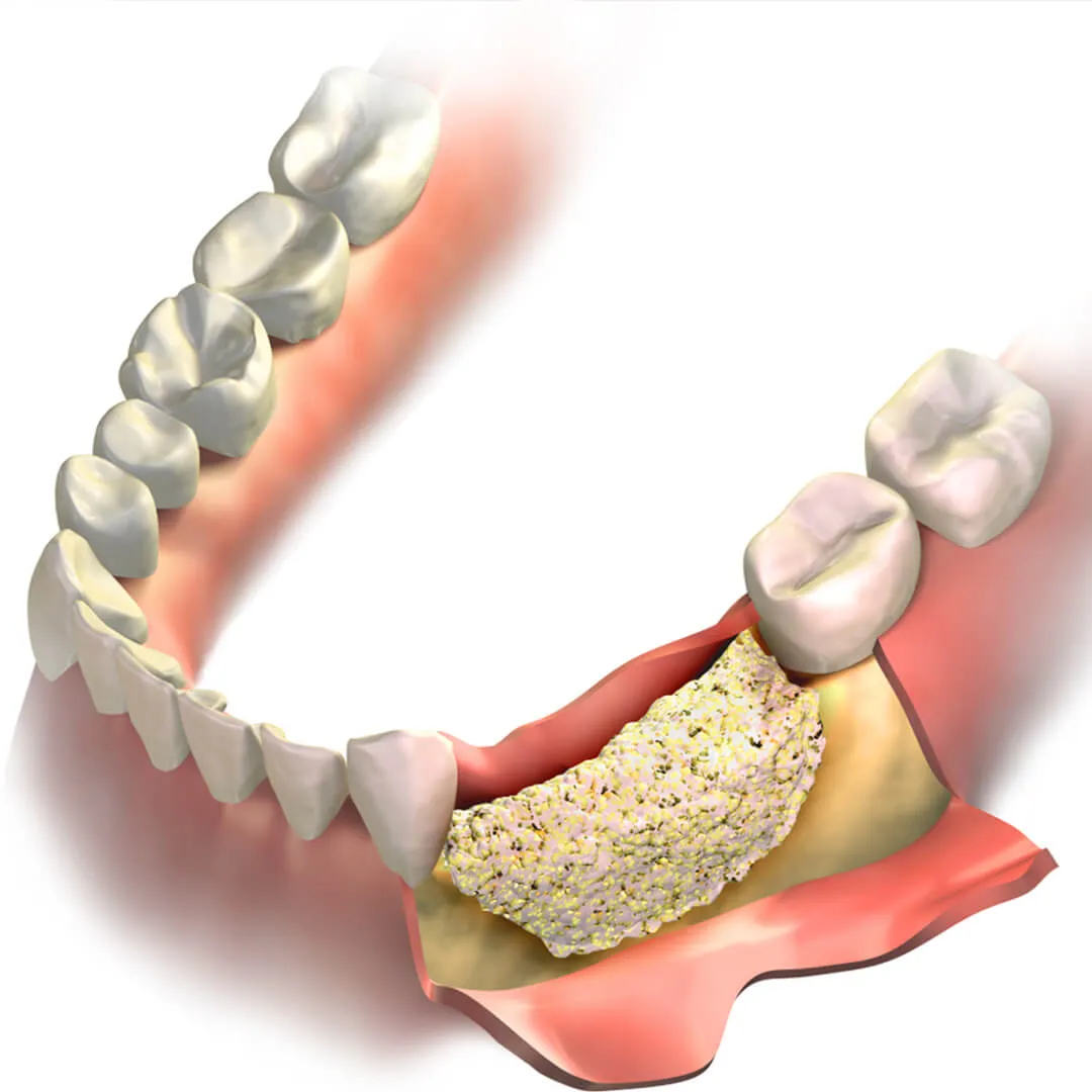 what is bone graft