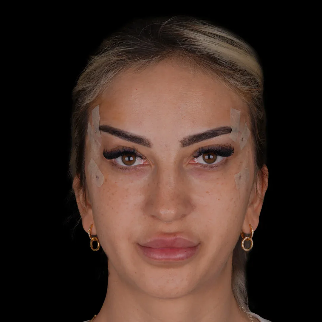 Medical Aesthetic before after 10