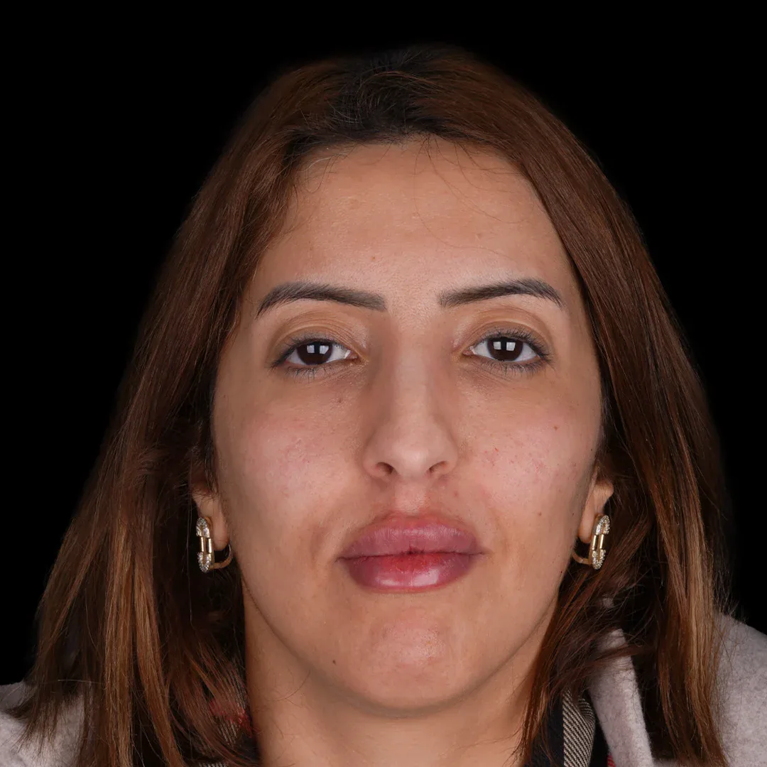 Medical Aesthetic before after 11