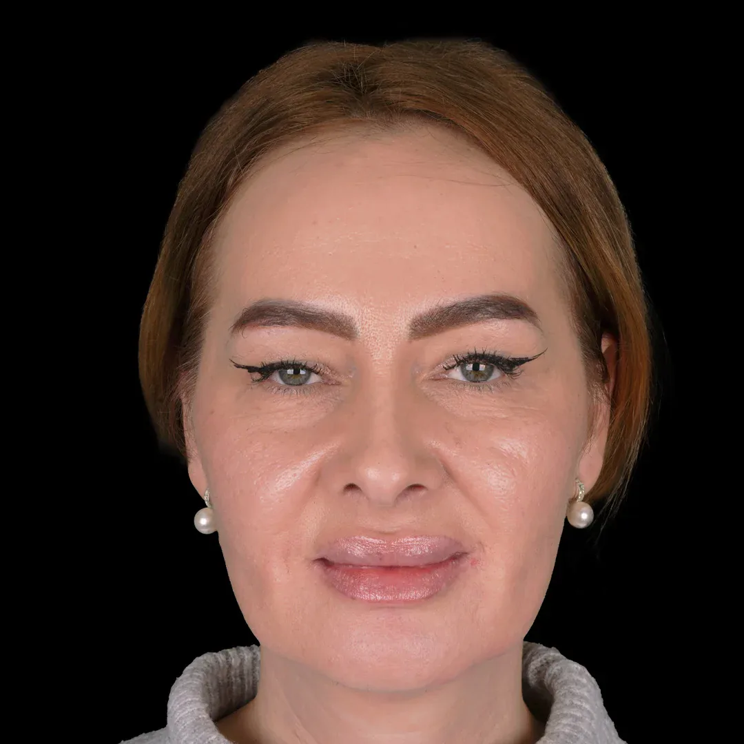 Medical Aesthetic before after 23