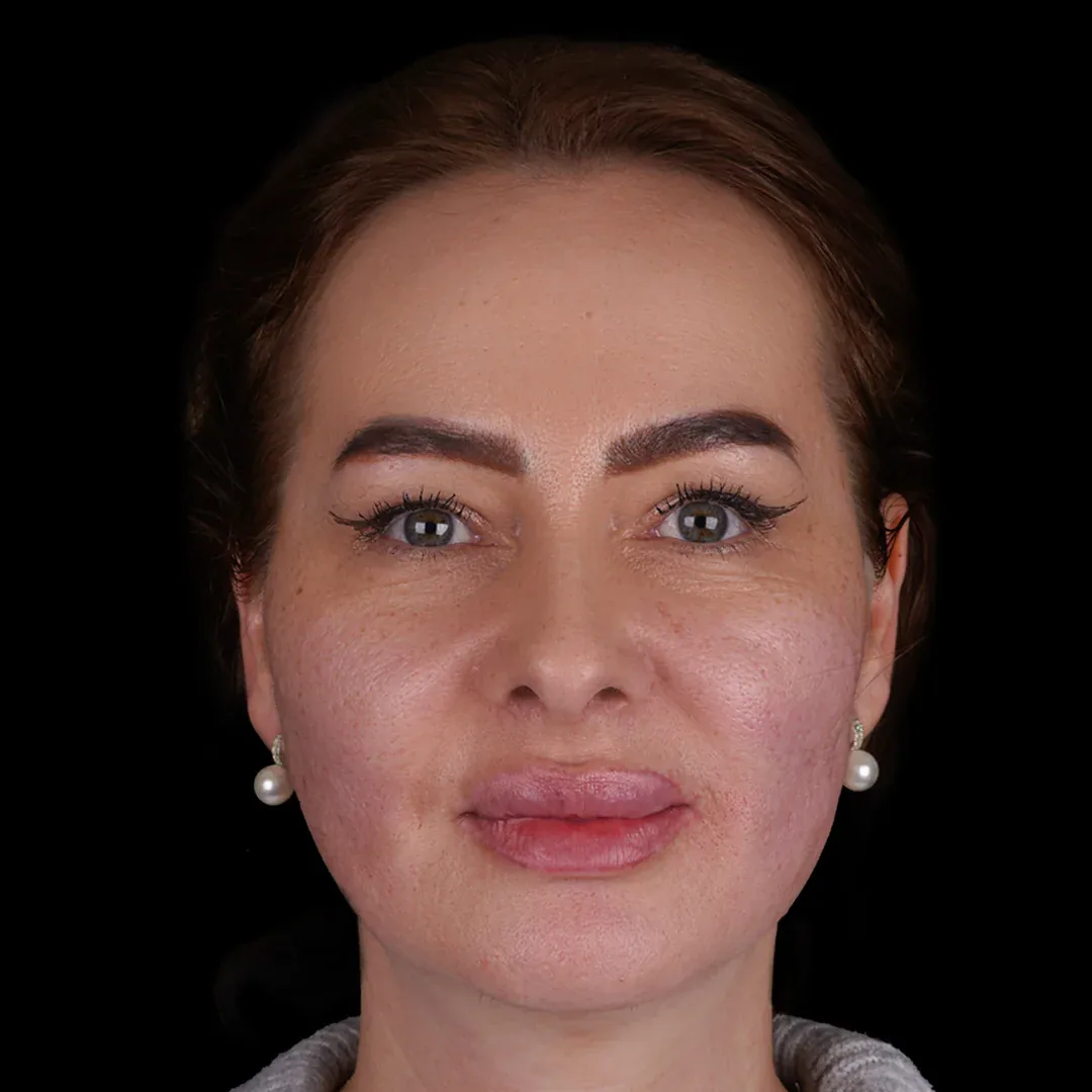 Medical Aesthetic before after 24