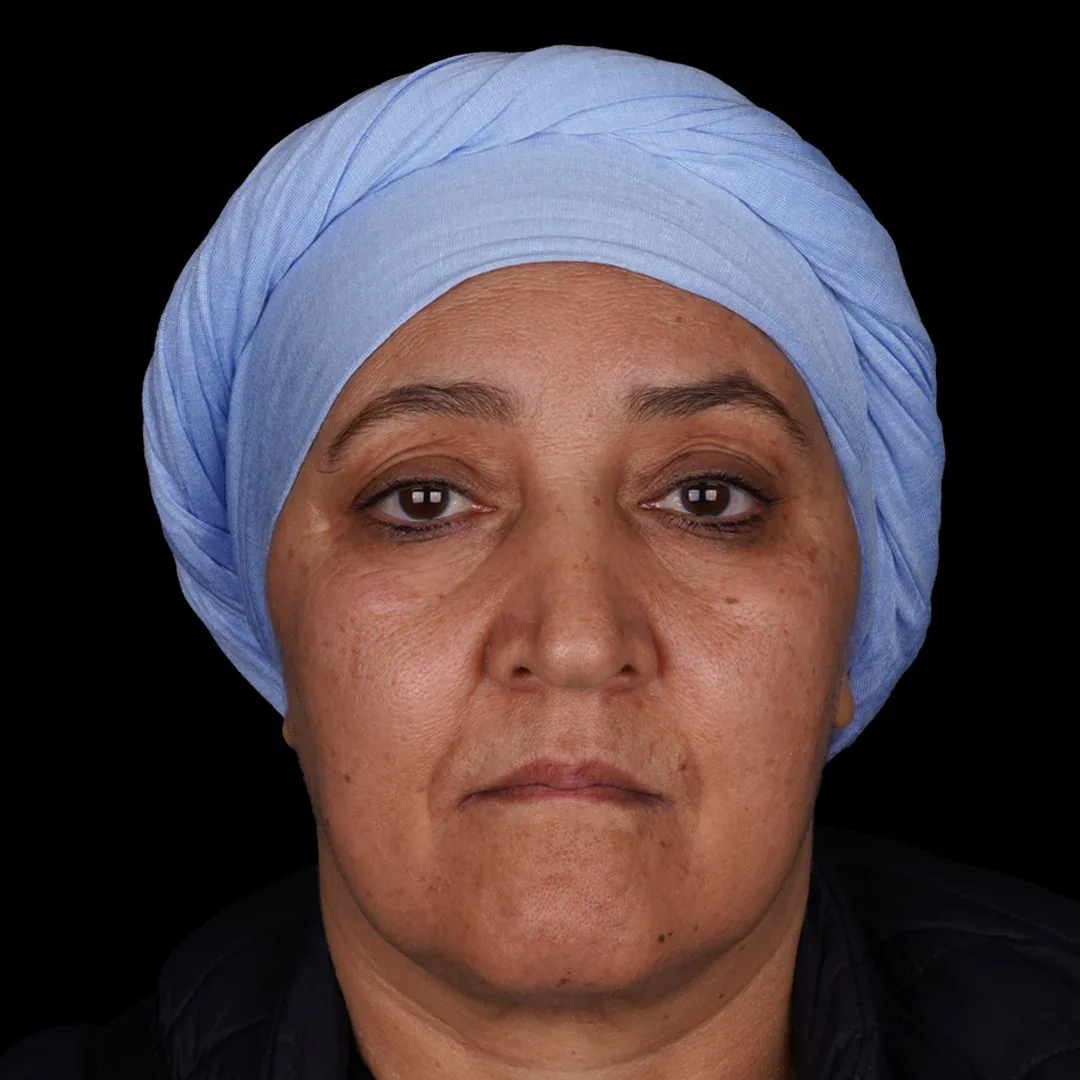 Medical Aesthetic before after 26