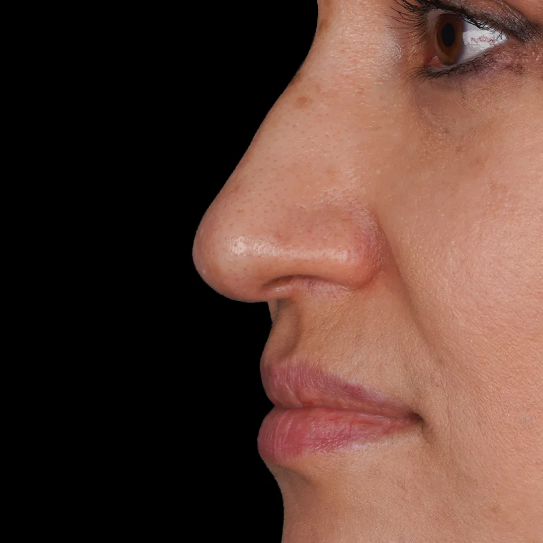 Medical Aesthetic before after 5