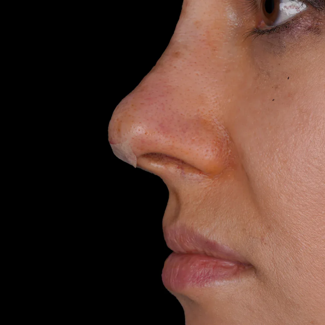 Medical Aesthetic before after 6