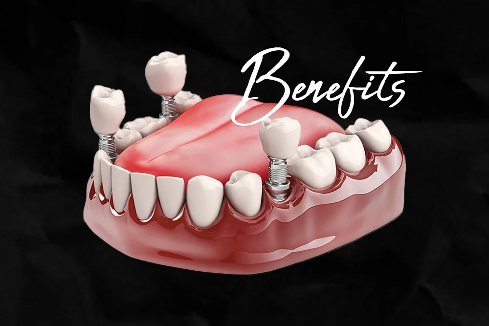 Benefits of Dental Implants