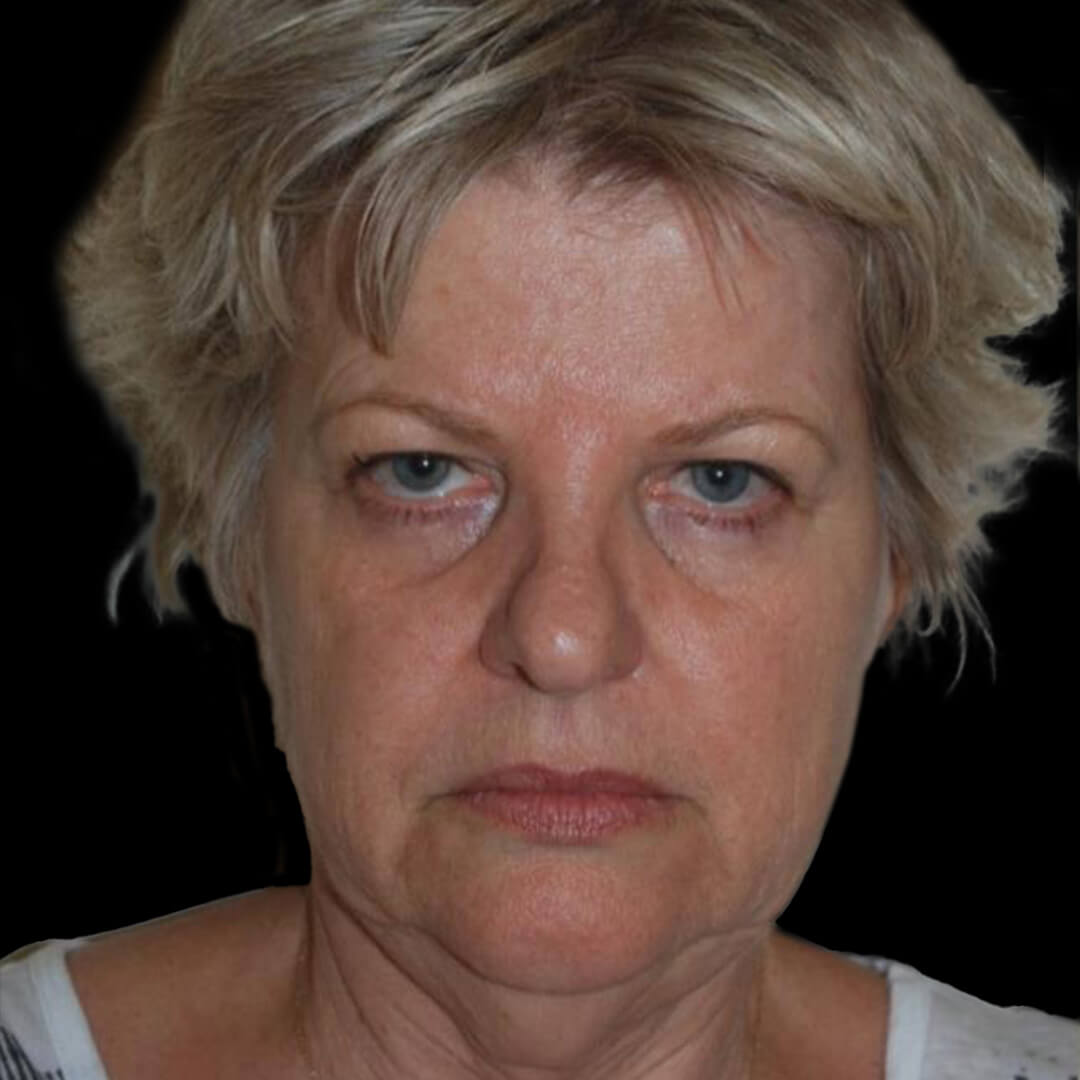 face lift gallery 1