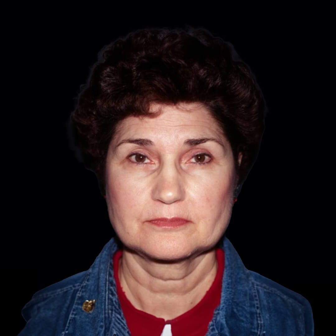 face lift gallery 10