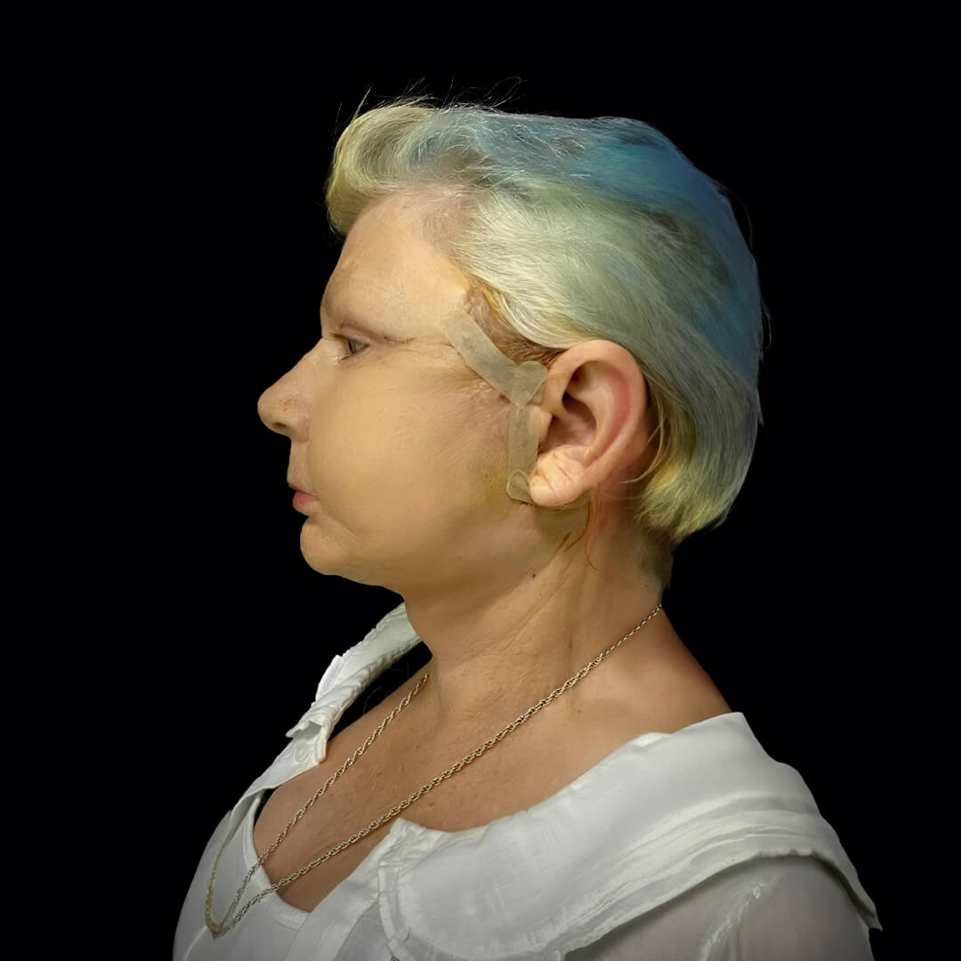 face lift gallery 12