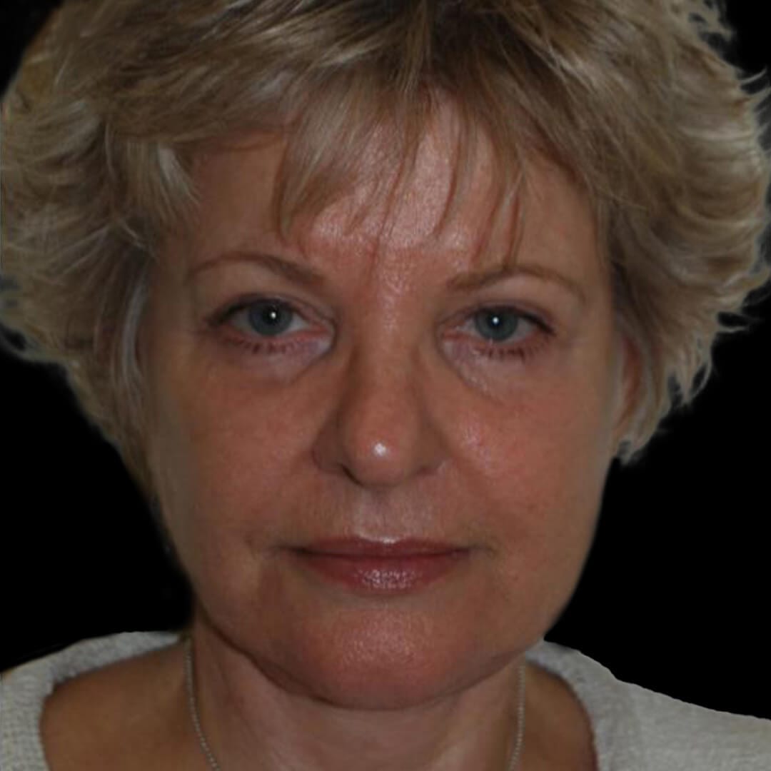 face lift gallery 2