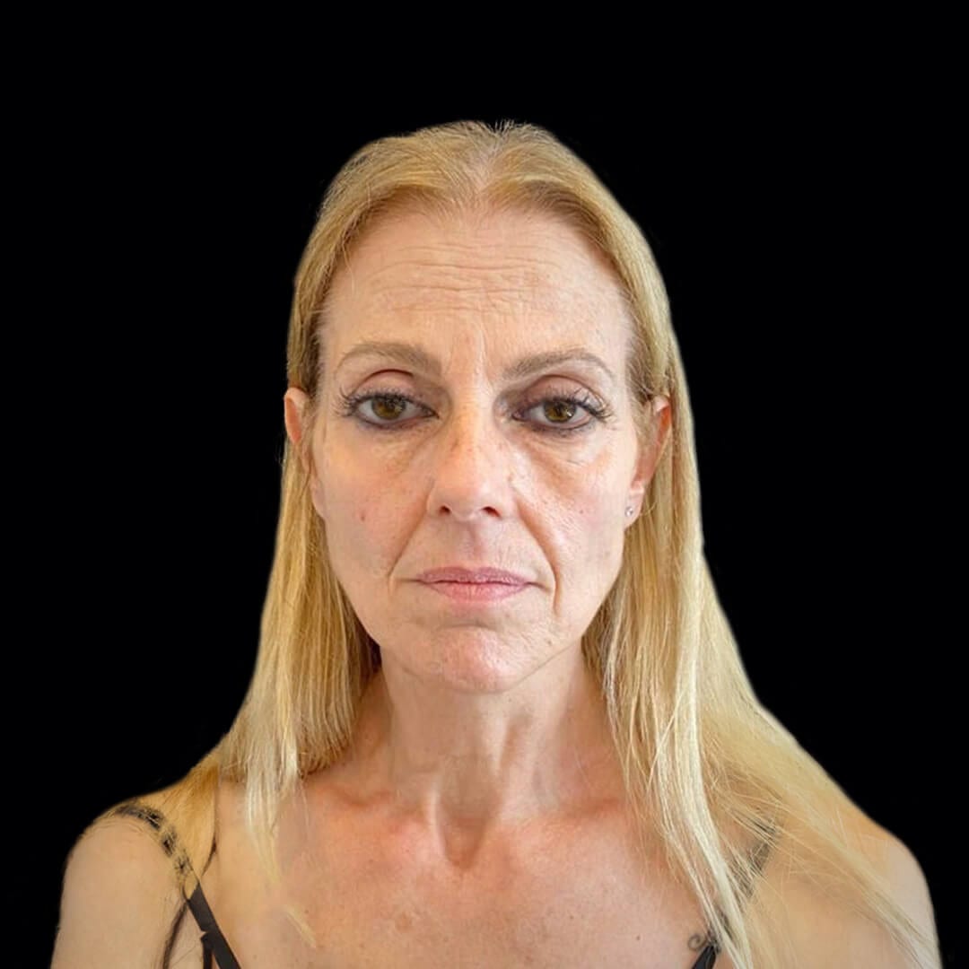 face lift gallery 5