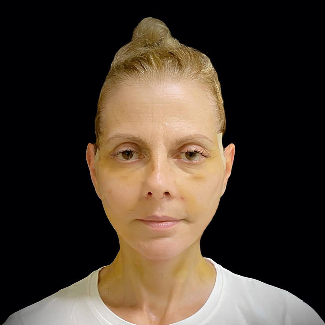 face lift gallery 6