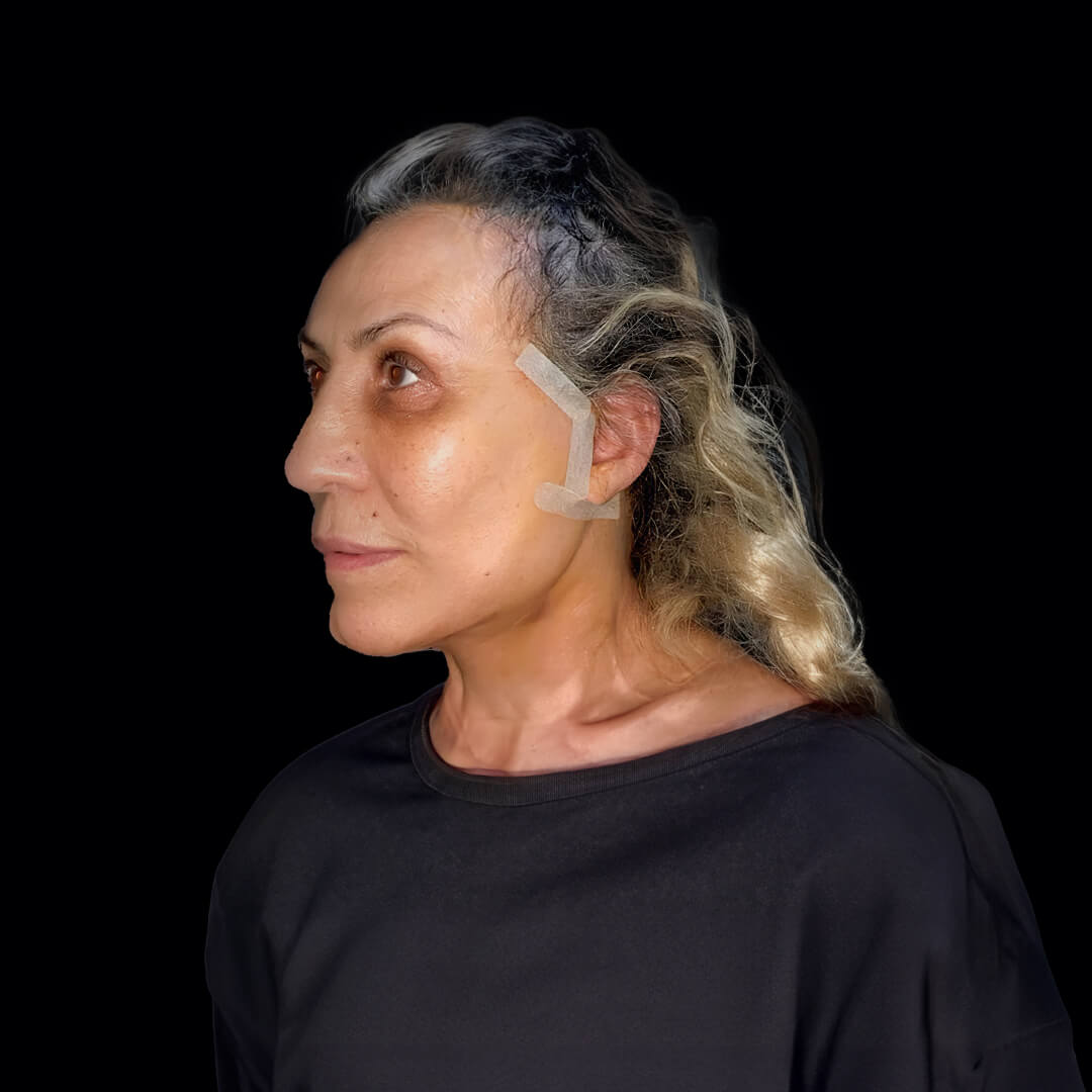 face lift gallery 8