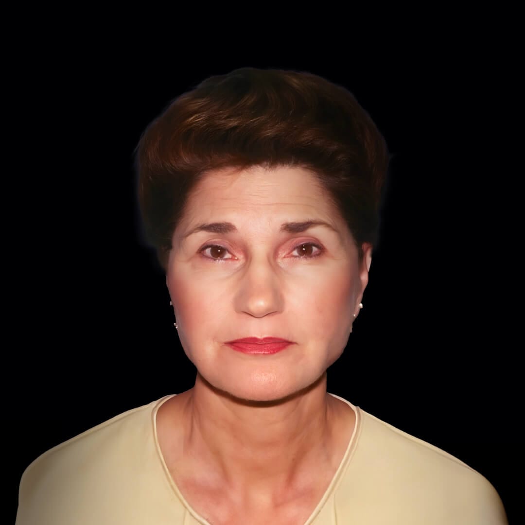 face lift gallery 9