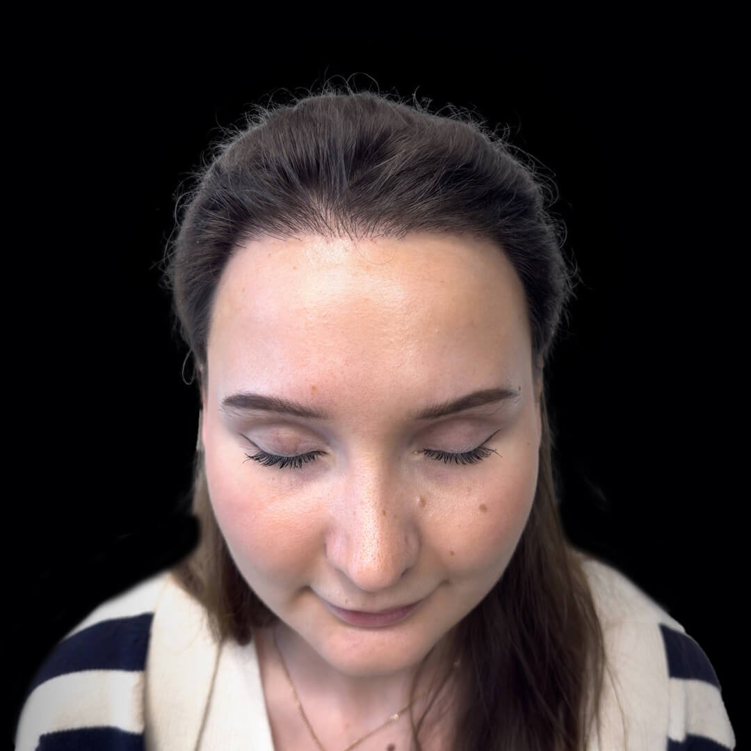 hair transplant gallery 10