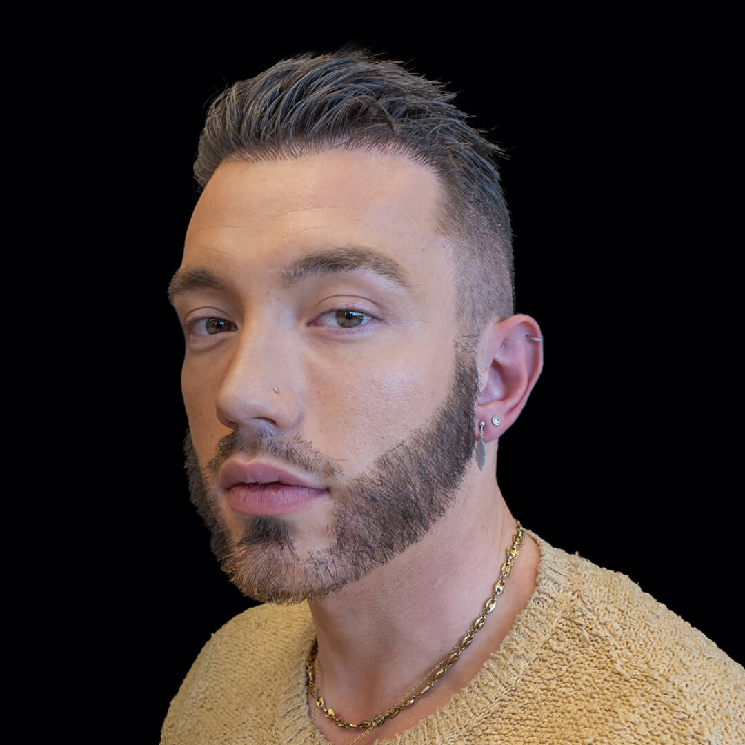 hair transplant gallery 4