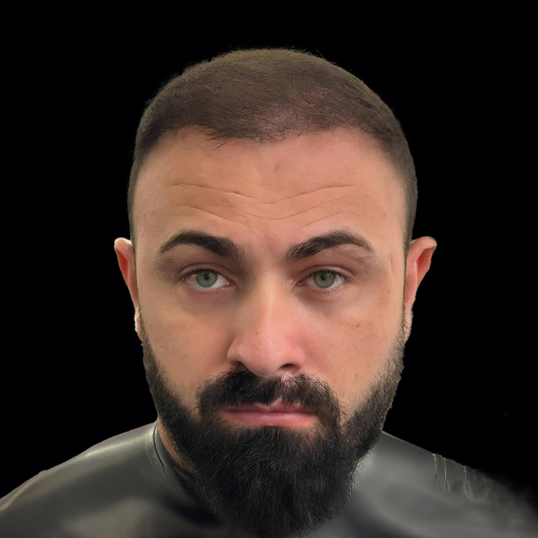 hair transplant gallery 8
