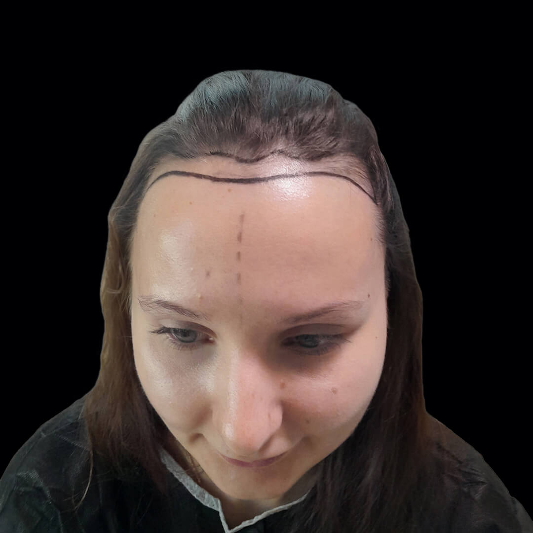 hair transplant gallery 9