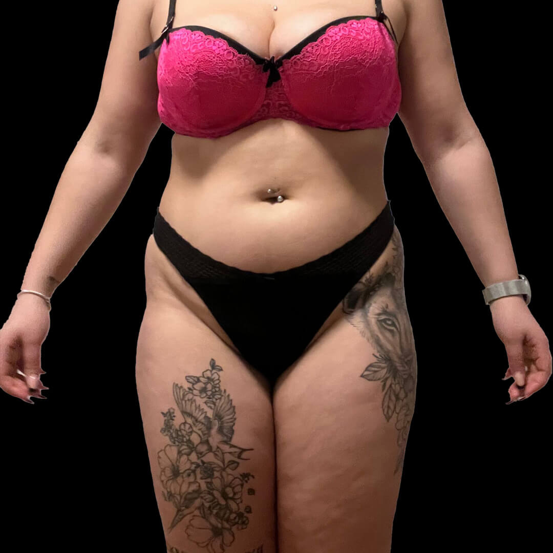 lipo gallery 1