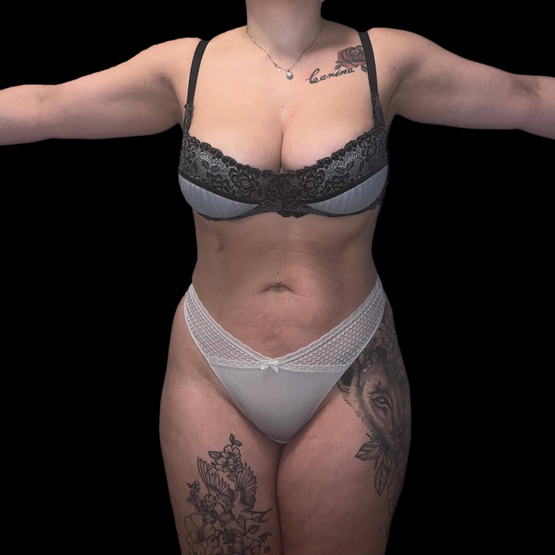lipo gallery 2