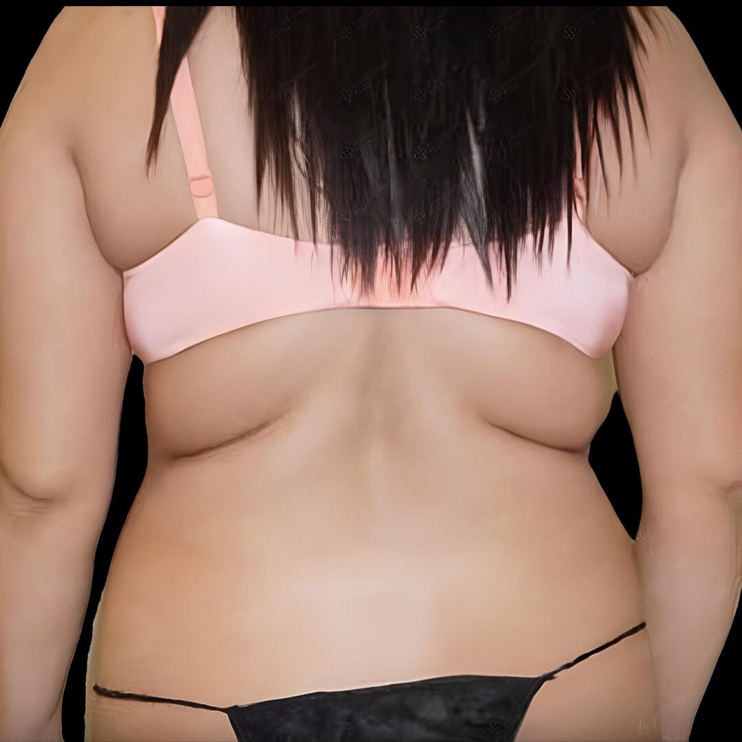 lipo gallery 3