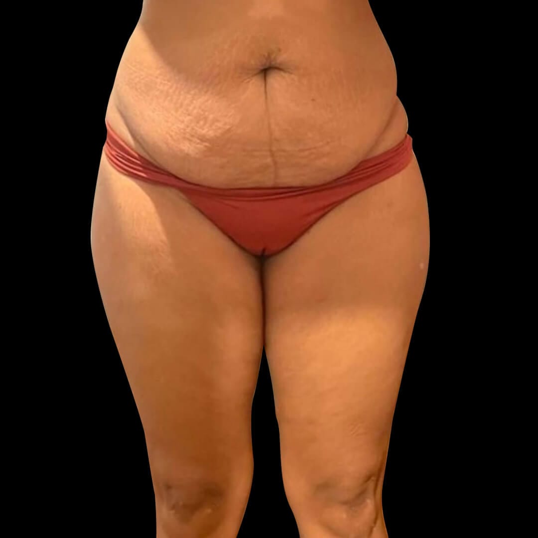 lipo tummy gallery 7