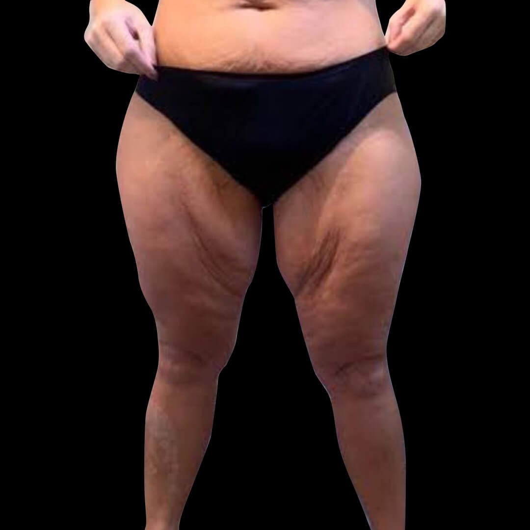thigh gallery 3