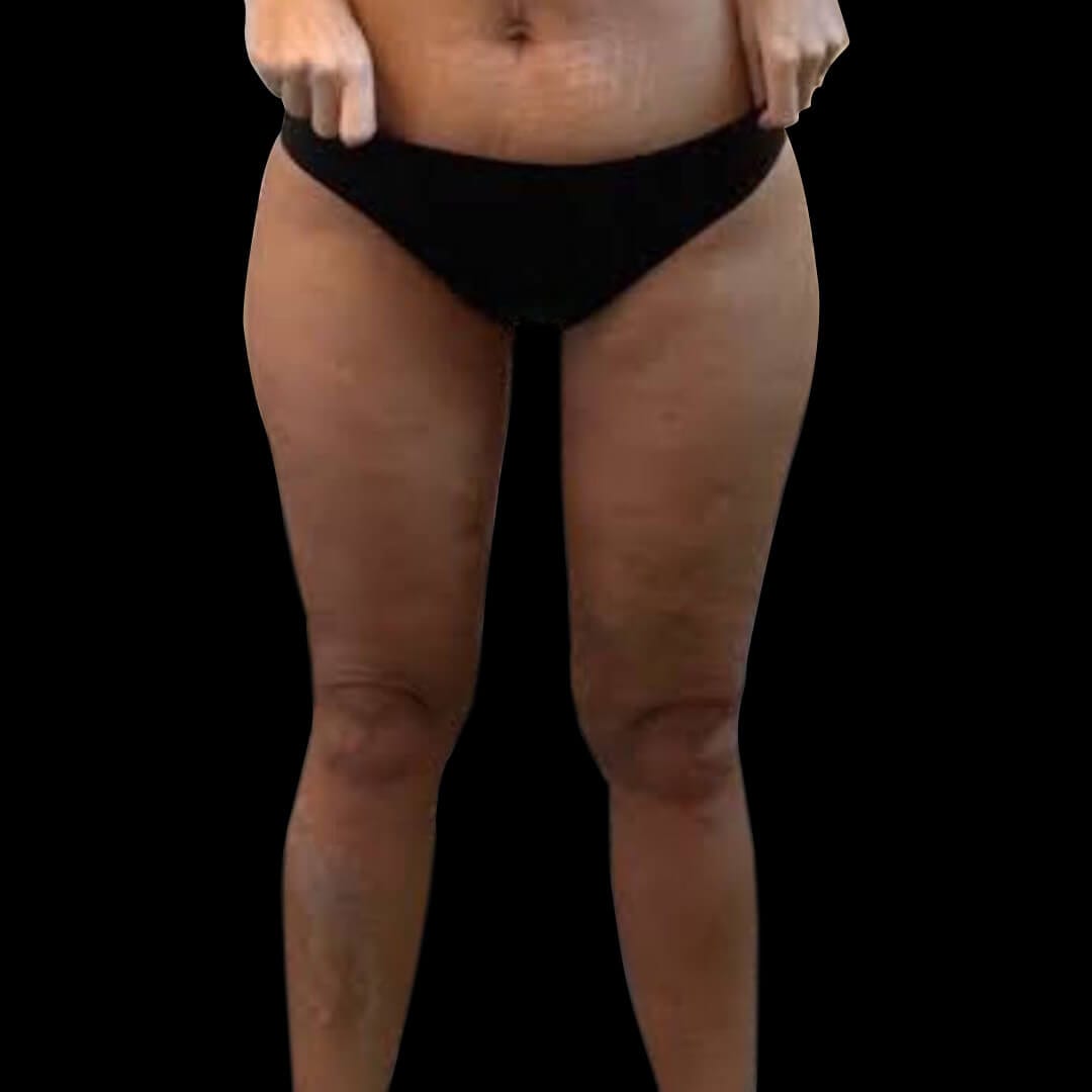 thigh gallery 4