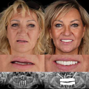 Zygomatic Implant Before After