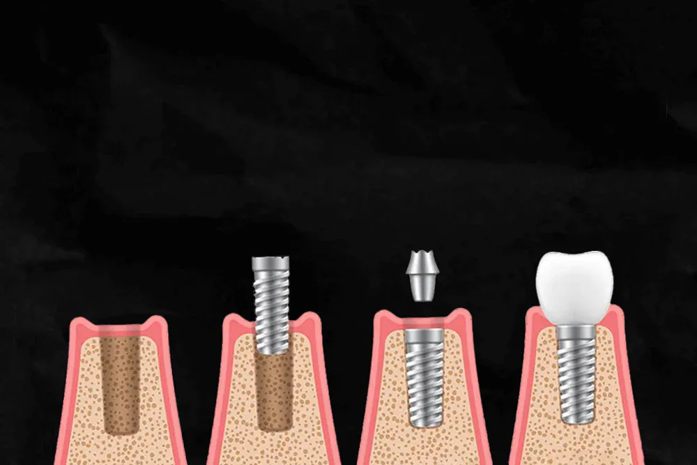 How Long Does a Dental Implant Procedure Take?