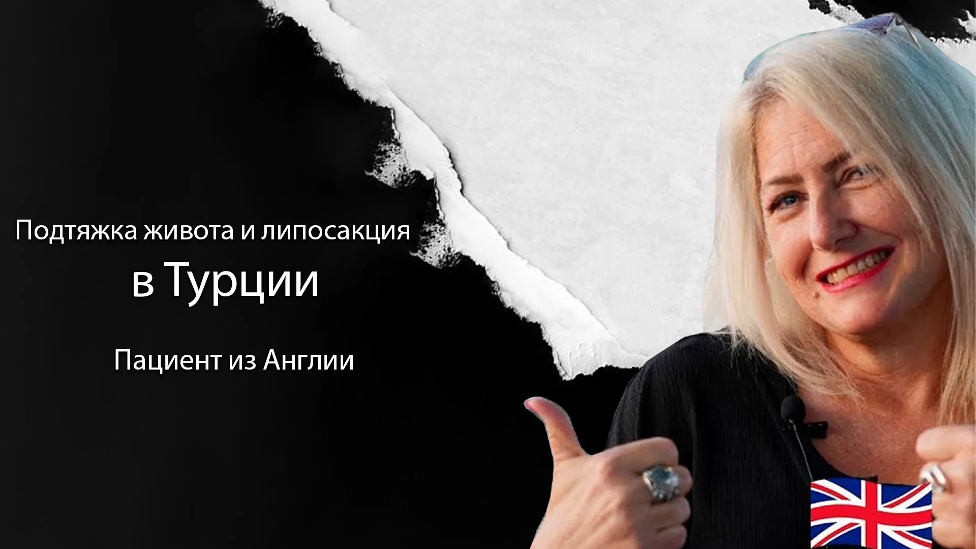 Абдоминопластика-подтяжка-живота-в-Стамбуле-Турция