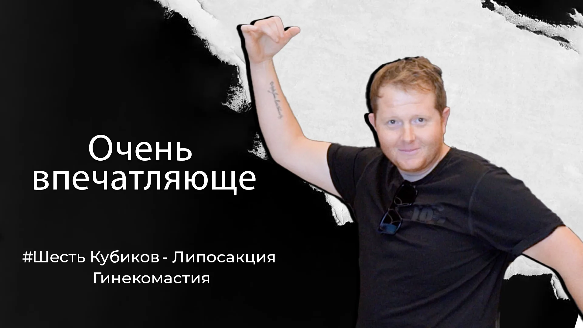 Гинекомастия-в-Стамбуле-Турция