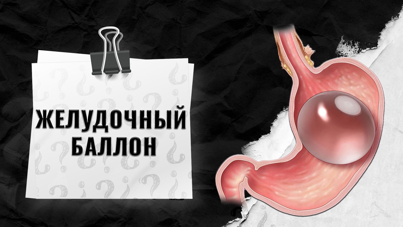 Желудочный-баллон-в-Стамбуле-Турция