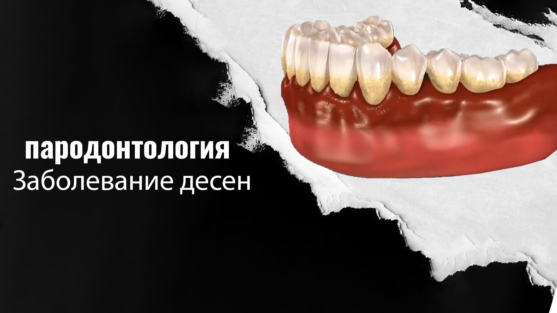 Пародонтология-в-Стамбуле-Турция