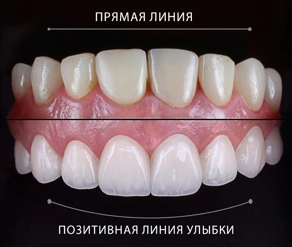 Преимущества голливудской улыбки