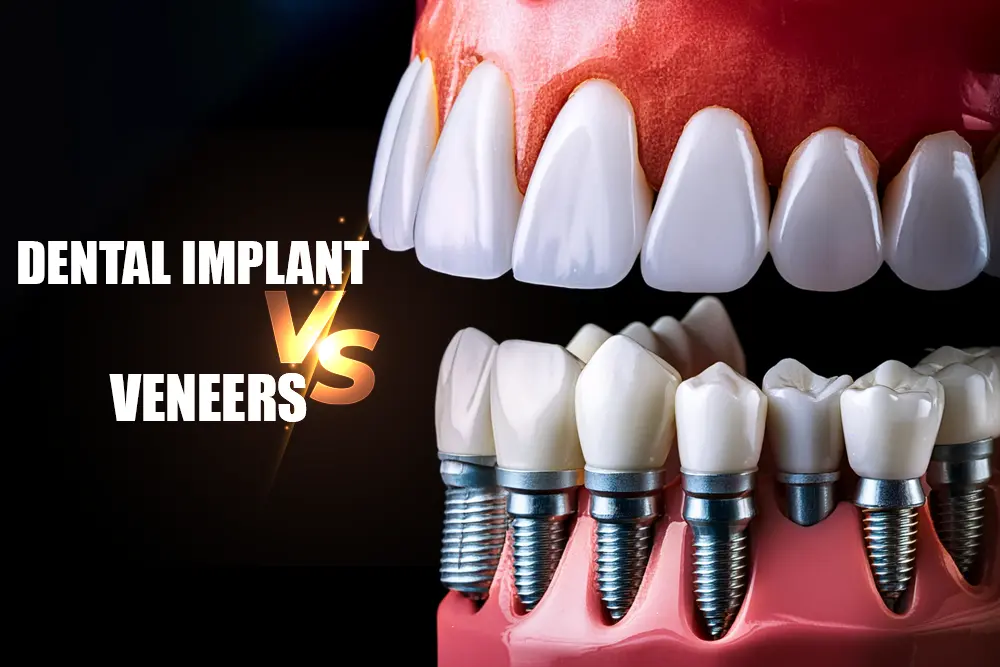 Dental Implant Vs Veneers