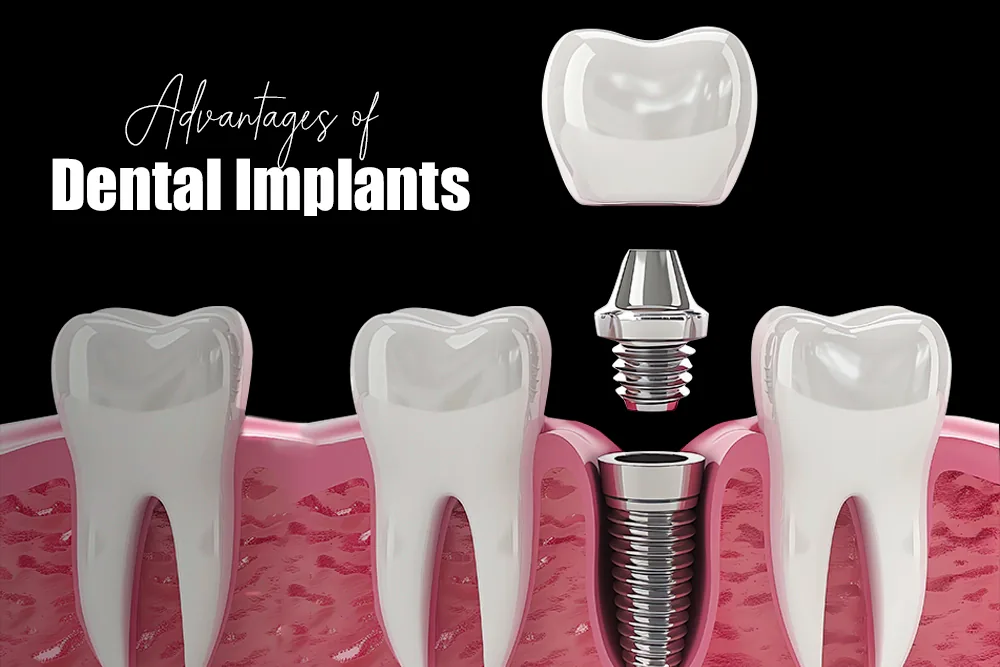 Advantages of Dental Implants