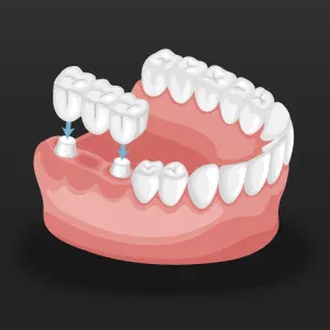 Advantages of Dental Implants Over Bridges