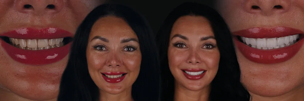 Hollywood-Smile-Without-Veneers